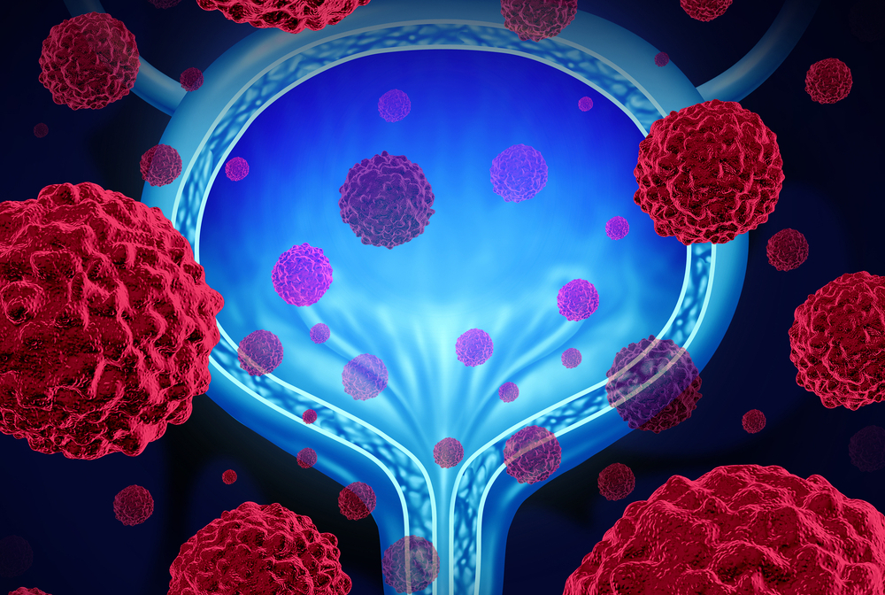 digital illustration of bladder cancer