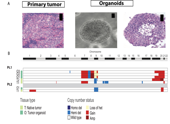 bishoy faltas bladder cancer lab vision